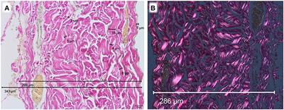 Industrial Processing Induces Pericardial Patch Degeneration